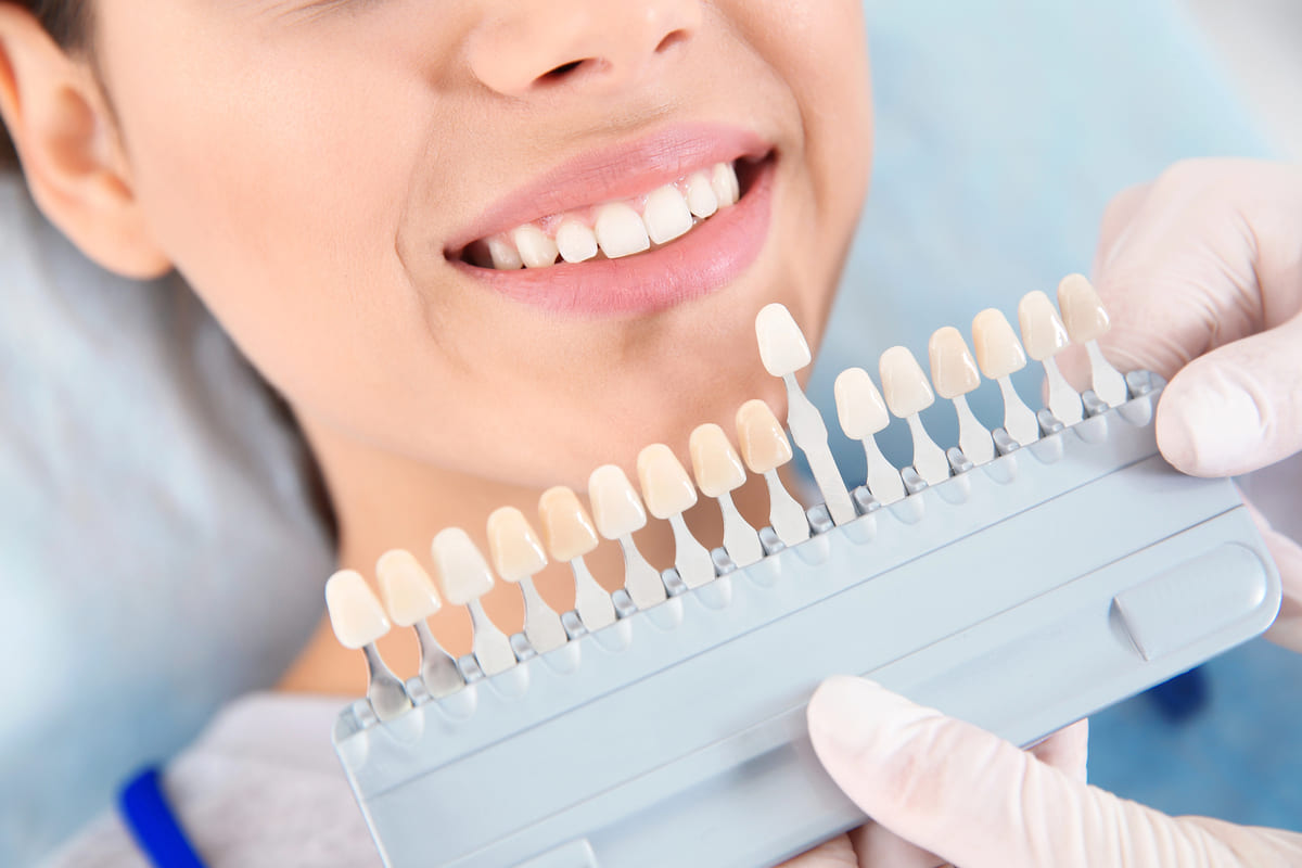 Teeth Whitening in DeLand, Florida - Zoom Whitening Results